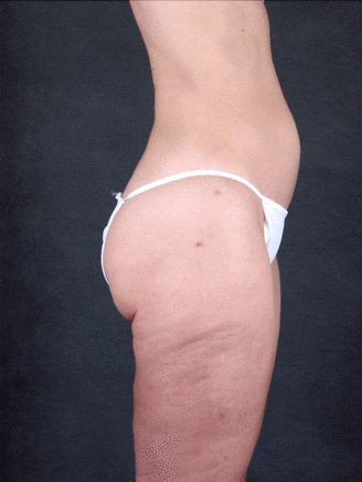 liposuction - patient 4276 - after 2 liposuction - patient 4276 - after 2