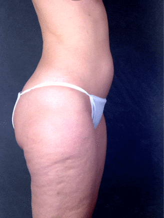 liposuction - patient 4276 - before 2 liposuction - patient 4276 - before 2