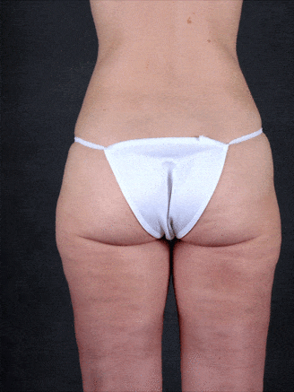 liposuction - patient 4276 - after 3 liposuction - patient 4276 - after 3
