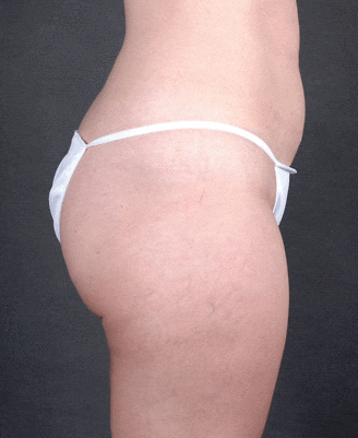 liposuction - patient 4012 - before 2 liposuction - patient 4012 - before 2