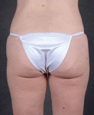 liposuction - patient 4012 - after 3 liposuction - patient 4012 - after 3