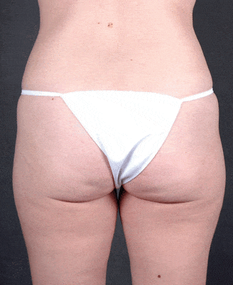 liposuction - patient 4012 - before 3 liposuction - patient 4012 - before 3