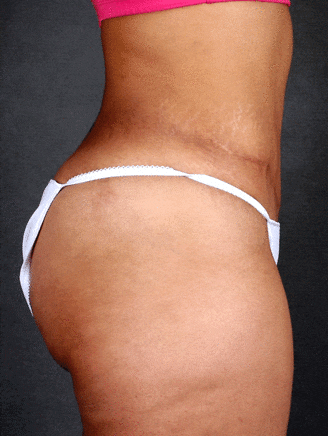 tummy tuck - patient 4859 - after 2 tummy tuck - patient 4859 - after 2
