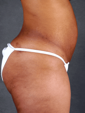 tummy tuck - patient 4859 - before 2 tummy tuck - patient 4859 - before 2