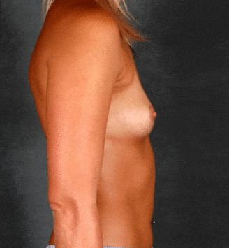 breast augmentation - patient 5235 - before 3 breast augmentation - patient 5235 - before 3