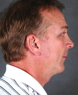 genioplasty - patient 5728 - after 2 genioplasty - patient 5728 - after 2