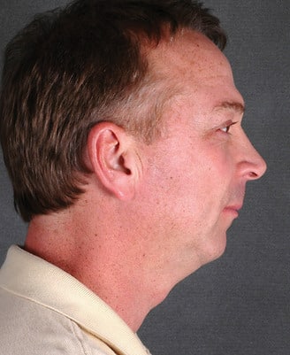 genioplasty - patient 5728 - before 2 genioplasty - patient 5728 - before 2
