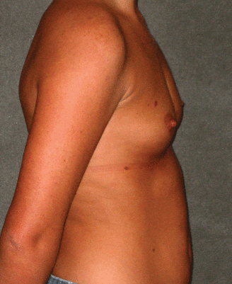breast augmentation - patient 5220 - before 3 breast augmentation - patient 5220 - before 3