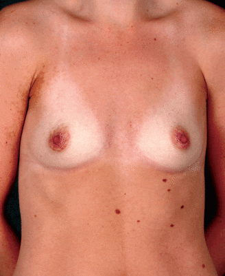 breast augmentation - patient 4198 - before 1 breast augmentation - patient 4198 - before 1