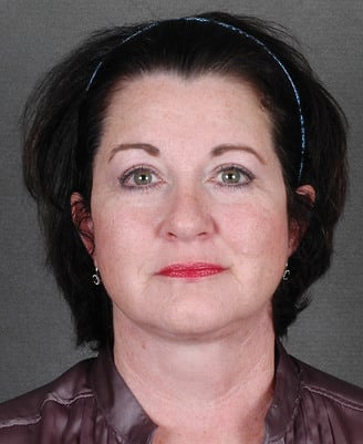 blepharoplasty - patient 5317 - after 1 blepharoplasty - patient 5317 - after 1