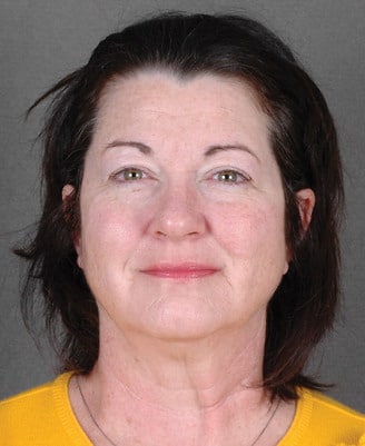 blepharoplasty - patient 5317 - before 1 blepharoplasty - patient 5317 - before 1