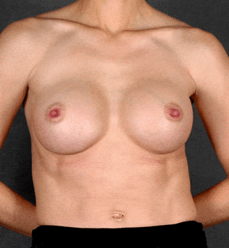 breast augmentation - patient 4255 - after 1 breast augmentation - patient 4255 - after 1