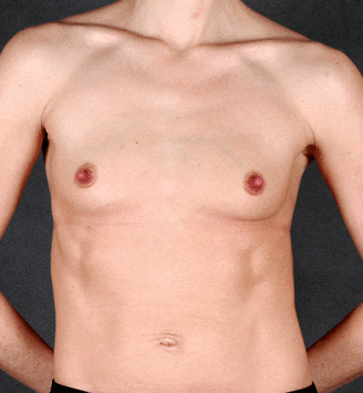 breast augmentation - patient 4255 - before 1 breast augmentation - patient 4255 - before 1