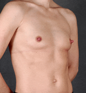 breast augmentation - patient 4255 - before 2 breast augmentation - patient 4255 - before 2