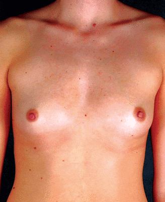 breast augmentation - patient 4551 - before 1 breast augmentation - patient 4551 - before 1