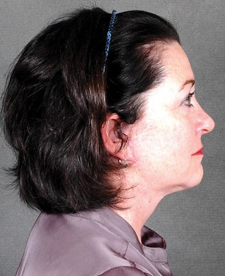 blepharoplasty - patient 5317 - after 2 blepharoplasty - patient 5317 - after 2