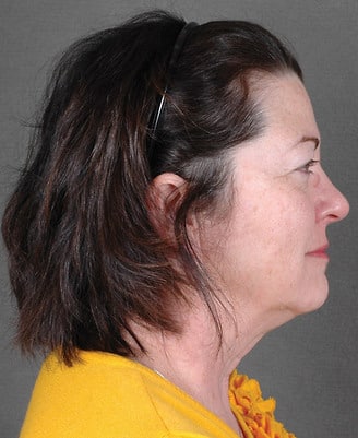 blepharoplasty - patient 5317 - before 2 blepharoplasty - patient 5317 - before 2