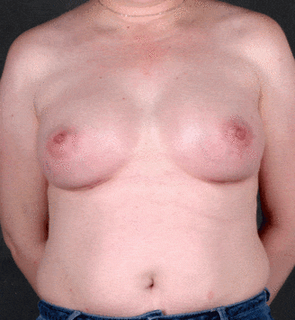 breast augmentation - patient 4453 - after 1 breast augmentation - patient 4453 - after 1
