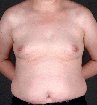 breast augmentation - patient 4453 - before 1 breast augmentation - patient 4453 - before 1