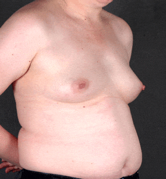 breast augmentation - patient 4453 - before 2 breast augmentation - patient 4453 - before 2