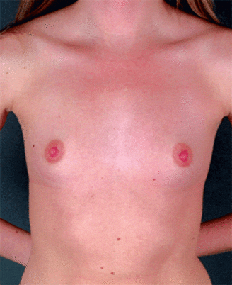 breast augmentation - patient 4377 - before 1 breast augmentation - patient 4377 - before 1