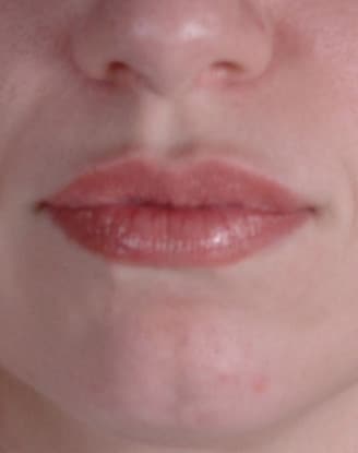 juvéderm - patient 6093 - after 1 juvéderm - patient 6093 - after 1