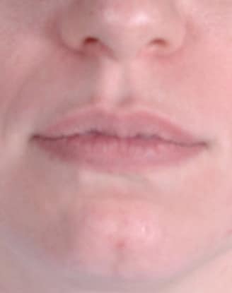 juvéderm - patient 6093 - before 1 juvéderm - patient 6093 - before 1