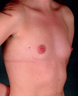breast augmentation - patient 4377 - before 2 breast augmentation - patient 4377 - before 2
