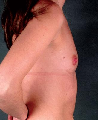 breast augmentation - patient 4377 - before 3 breast augmentation - patient 4377 - before 3