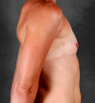 breast augmentation - patient 4513 - before 3 breast augmentation - patient 4513 - before 3