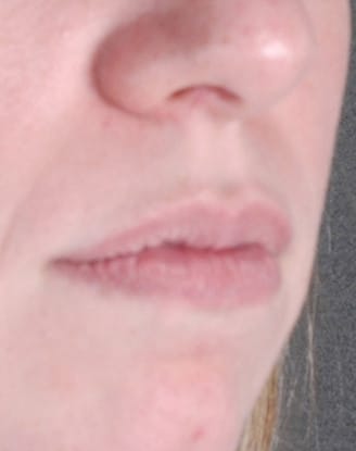 juvéderm - patient 6093 - before 2 juvéderm - patient 6093 - before 2