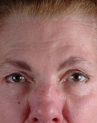 botox cosmetic - patient 6067 - after 1 botox cosmetic - patient 6067 - after 1