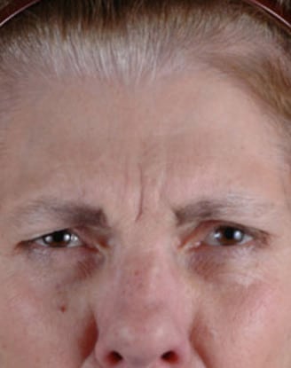 botox cosmetic - patient 6067 - before 1 botox cosmetic - patient 6067 - before 1