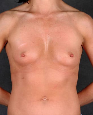 breast augmentation - patient 4581 - before 1 breast augmentation - patient 4581 - before 1