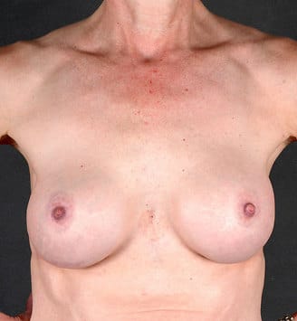 breast augmentation - patient 4320 - after 1 breast augmentation - patient 4320 - after 1