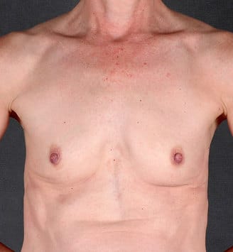 breast augmentation - patient 4320 - before 1 breast augmentation - patient 4320 - before 1