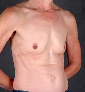 breast augmentation - patient 4320 - before 2 breast augmentation - patient 4320 - before 2