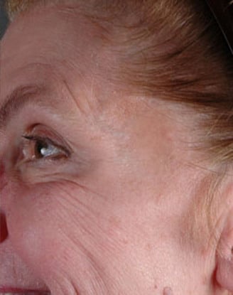 botox cosmetic - patient 6067 - after 2 botox cosmetic - patient 6067 - after 2