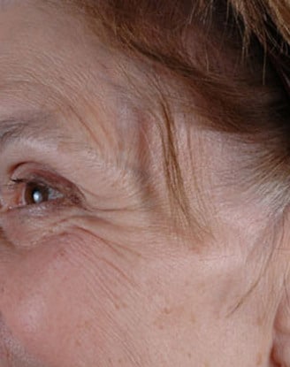 botox cosmetic - patient 6067 - before 2 botox cosmetic - patient 6067 - before 2