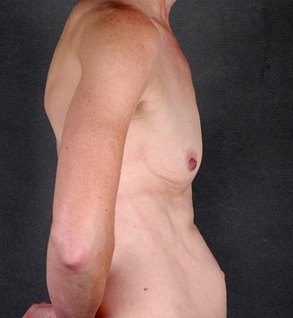 breast augmentation - patient 4320 - before 3 breast augmentation - patient 4320 - before 3