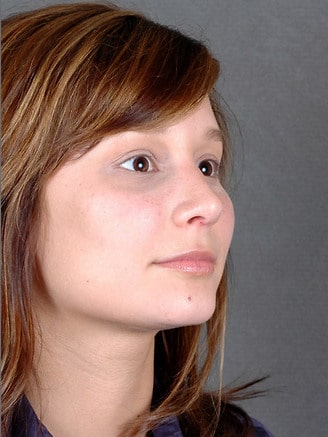 rhinoplasty - patient 5839 - after 1 rhinoplasty - patient 5839 - after 1