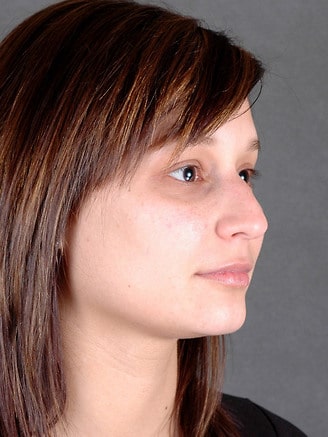 rhinoplasty - patient 5839 - before 1 rhinoplasty - patient 5839 - before 1