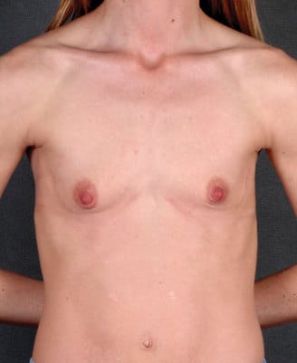 breast augmentation - patient 5269 - before 1 breast augmentation - patient 5269 - before 1