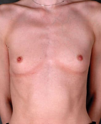 breast augmentation - patient 4849 - before 1 breast augmentation - patient 4849 - before 1