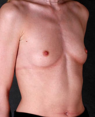 breast augmentation - patient 4849 - before 2 breast augmentation - patient 4849 - before 2