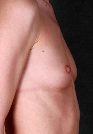 breast augmentation - patient 4849 - before 3 breast augmentation - patient 4849 - before 3