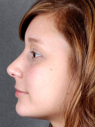 rhinoplasty - patient 5839 - after 2 rhinoplasty - patient 5839 - after 2