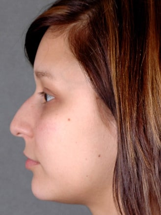 rhinoplasty - patient 5839 - before 2 rhinoplasty - patient 5839 - before 2
