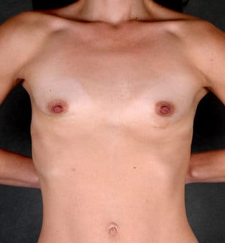 breast augmentation - patient 4668 - before 1 breast augmentation - patient 4668 - before 1