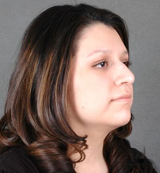 rhinoplasty - patient 5812 - before 2 rhinoplasty - patient 5812 - before 2